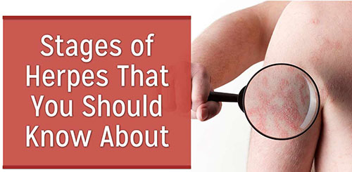 Stages of Herpes Outbreakv