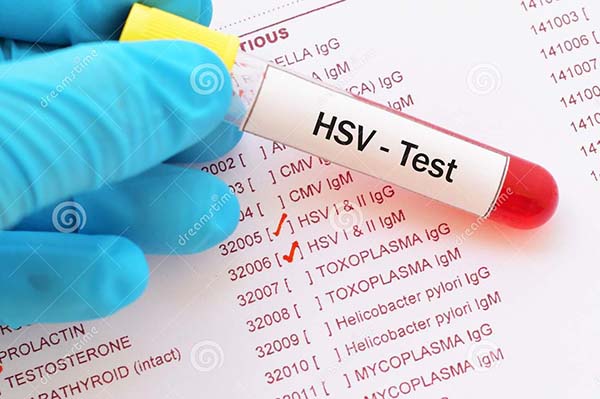 Herpes testing