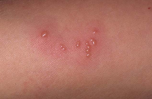what does a herpe sore look like,harpies skin disease images,